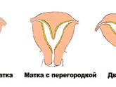 Двурогая матка