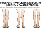 Комплекс упражнений и приемы массажа для вальгуса и варуса ног.