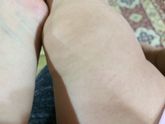 Пятна по всему телу
