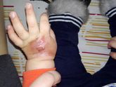 Мазь от ожогов?
