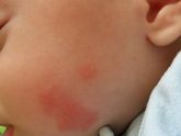 Аллергия у ребенка.