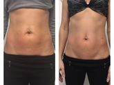 Коррекция фигуры на аппарате power shape2