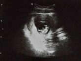14 недель (6я беременность)фото.узи...