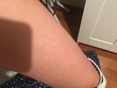 Сыпь на ногах