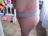 Какое есть проверенное действующее средство от растяжек??