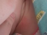 Аллергия или потничка?