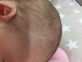 Аллергия? Потничка? Или гормональные?