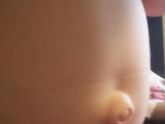 Попочная грыжа