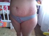 Какое есть проверенное действующее средство от растяжек??