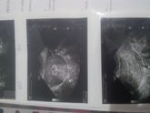 Помогите разобраться ХГЧ и УЗИ