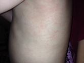 Подскажите, это аллергия?