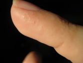 Волдырики на пальцах ожог или аллергия?