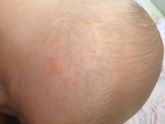 Подскажите что за высыпания?