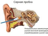 «Как разложить уши», или Как избавиться от заложенности ушей