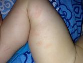 Мамы у кого детки склонны к аллергии