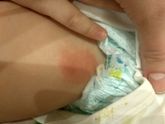 Мамочки, что это выскочило у ребенка?
