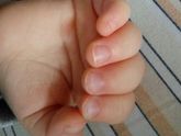 Слоятся ногти у ребенка