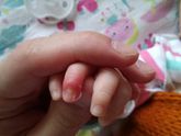 Паронихий у новорожденного или содрала возле кутикулы