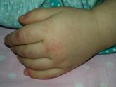 Что это аллергия или что то кожное?