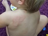 Аллергия или крапивница