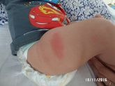 Сходили на прием в 2 мес. Реакция на Превенар. Гранулема.