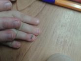 У кого удаляли ноготь?