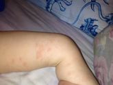 Мамы у кого детки склонны к аллергии