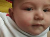 Аллергия на цветную капусту?