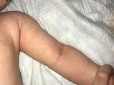 Потница или аллергия?