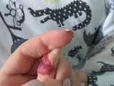 Гемангиома у ребёнка. Кто сталкивался?