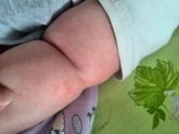 Что это за сыпь?
