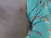 У ребёнка покраснело вокруг соска и уплотнение