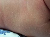 Ребенку 2 месяца сухая и шершавая кожа