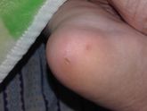 не пойму что это такое у сына на пяточке..(фото прилагается)
