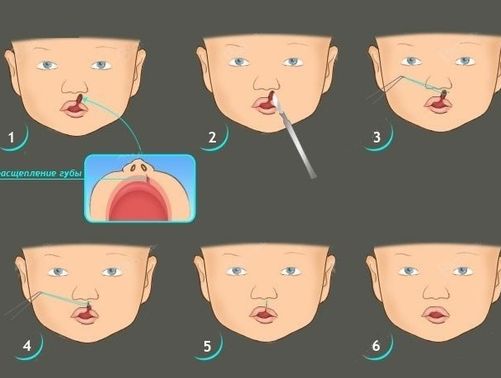 Заячья губа у детей и взрослых: причины, симптомы, лечение