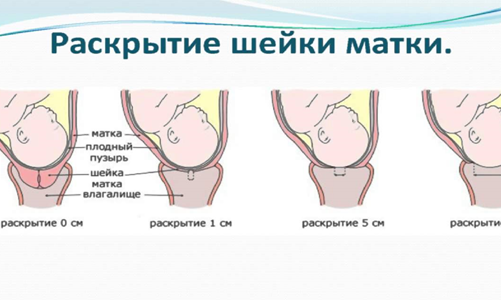 Проясняем причину сокращения шейки матки во время беременности