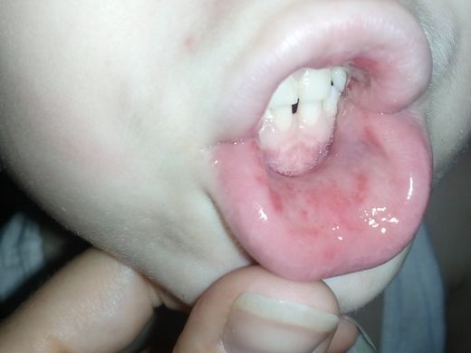 Виды поражений слизистой полости рта