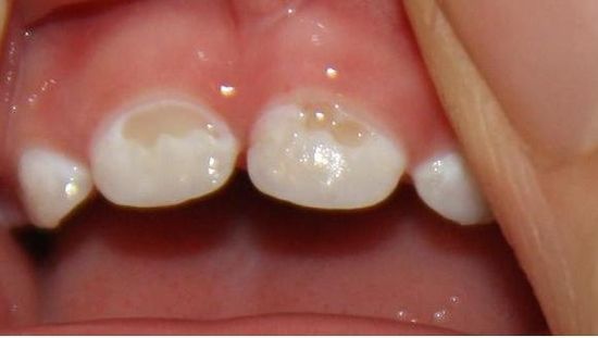 У дочки портятся зубы - 1 год и 4 месяца. как лечат таким крошкам?