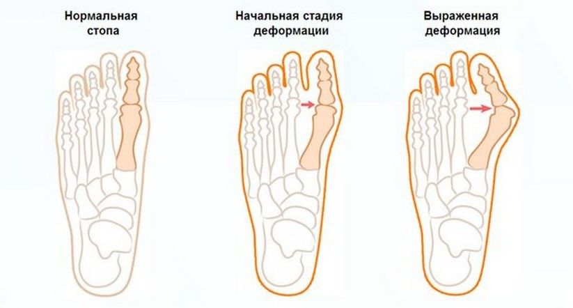 Как убрать косточку на ноге