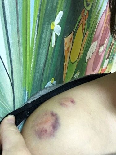 Грипп и фебрильные судороги
