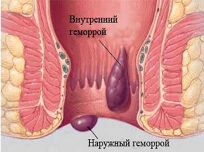 Геморрой - как следствие тромбофилии