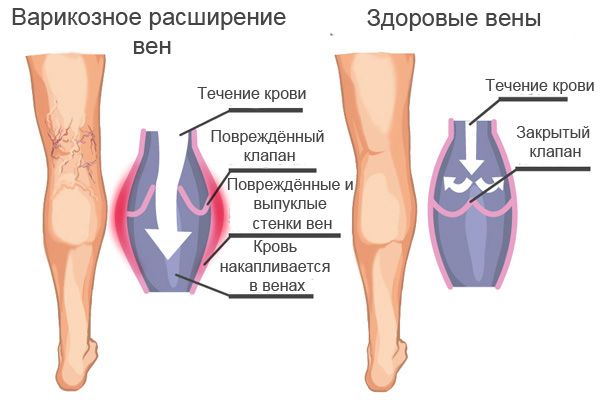 Марафон #ясмогу 2.0 день 20 Тренировки при варикозе
