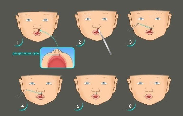 Заячья губа и Волчья пасть. Причины развития и лечение