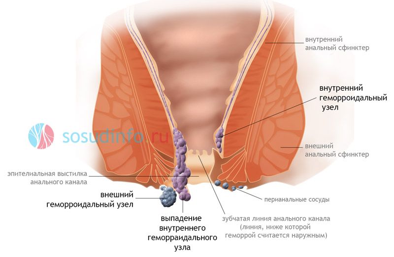 Геморрой - как следствие тромбофилии