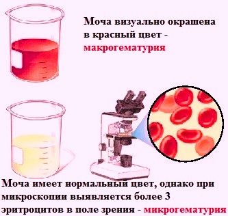 Эритроциты в общем анализе мочи