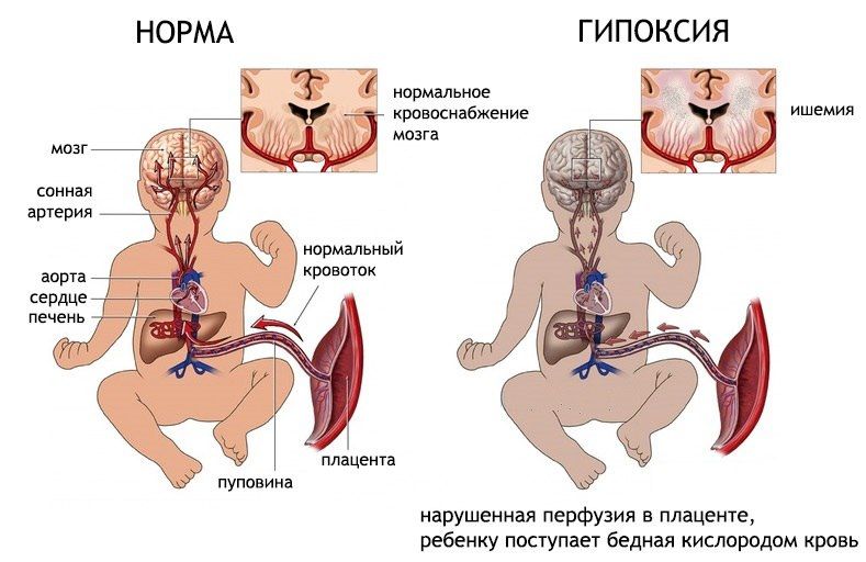 ФПН при беременности. Что это?