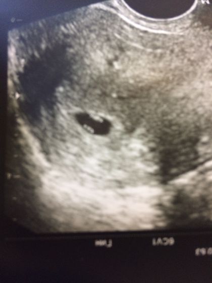 Фото узи 3 недели беременности двойняшек