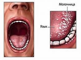 Стоматит. Причины и лечение.