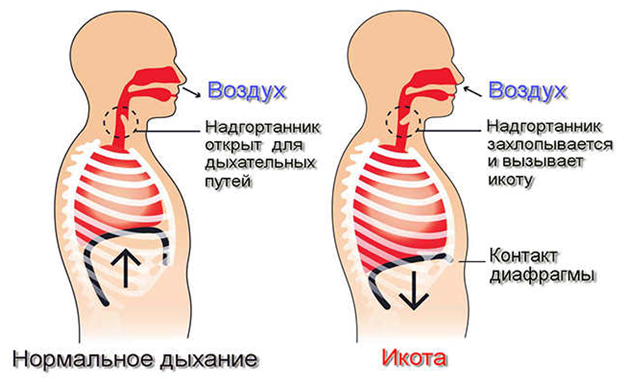 Частая икота