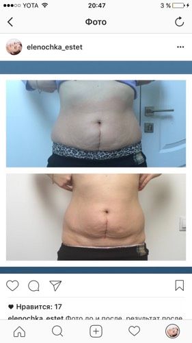 Коррекция фигуры на аппарате power shape2